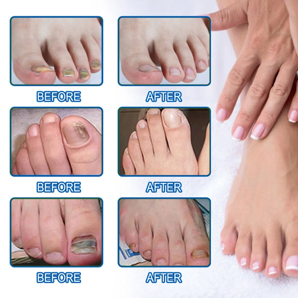 Box of 32 nail repair adhesive bandages, each patch measuring 6.1 by 3.5 centimetres.