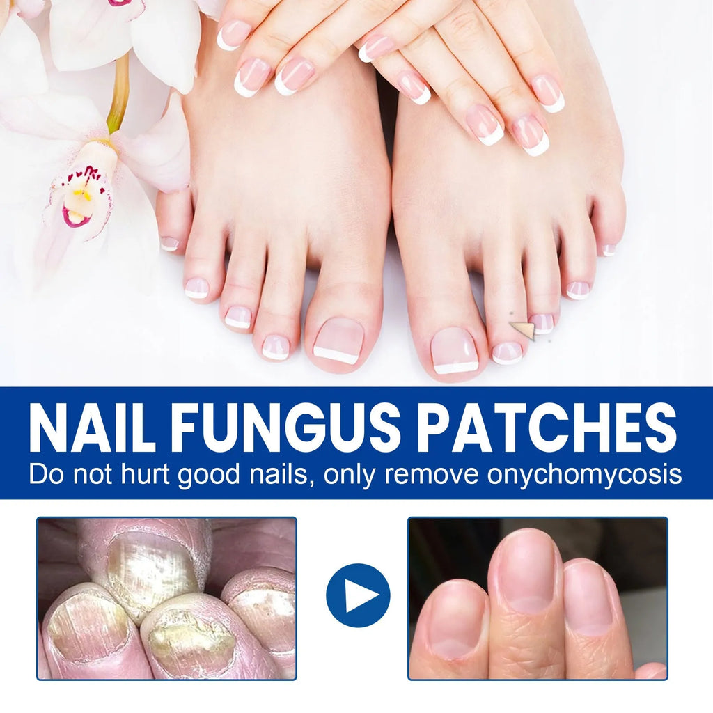 Box of 32 nail repair adhesive bandages, each patch measuring 6.1 by 3.5 centimetres.
